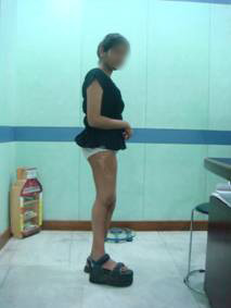 FemurLengthning before surgery