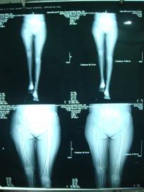 FemurLengthning_before treatment