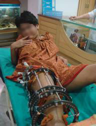 during treatment - femur lengthning