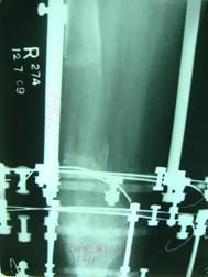 Femur_Lengthning
