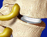 Spine Surgeries