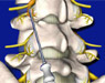 Spine Surgeries