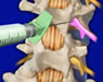 Spine Surgeries