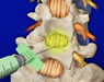 Spine Surgeries