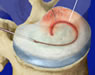 Spine Surgeries
