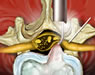 Spine Surgeries