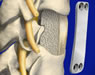 Spine Surgeries