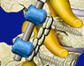 Spine Surgeries