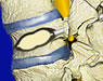 Spine Surgeries