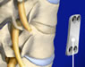 Spine Surgeries