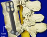 Spine Surgeries