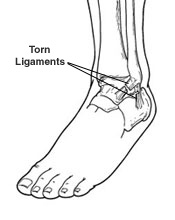 sprained ankle